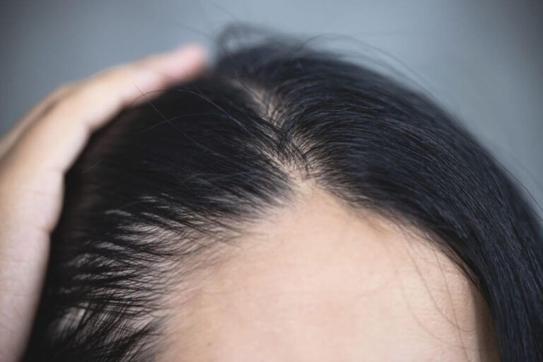 Nguyên nhân tóc bị mỏng? Cách khắc phục tình trạng tóc mỏng