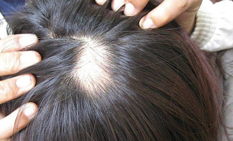 Làm thế nào để ngăn ngừa hói đầu?