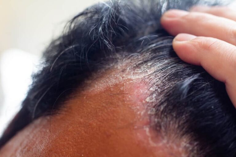 8 cách trị nấm da đầu tại nhà hiệu quả nhanh, dễ làm