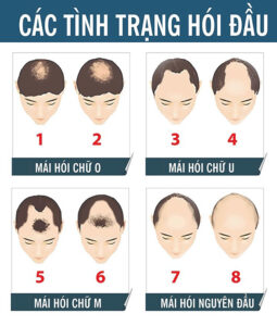 Có rất nhiều tình trạng hói đầu