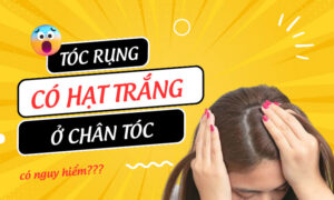 Tóc rụng có hạt trắng ở chân tóc