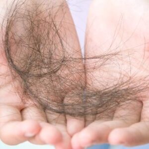 Rụng tóc nhiều có thể dẫn đến hói đầu