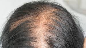 Tóc rụng nhiều gây nên hói đầu