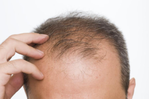 Rụng tóc nhiều dẫn đến hói đầu 