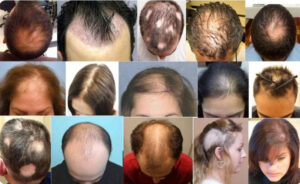 Có rất nhiều kiểu rụng tóc từng mảng 