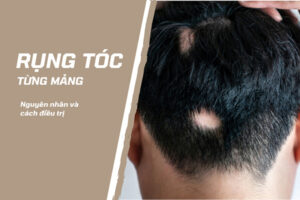 Rụng tóc từng mảng gây mất thẩm mỹ 