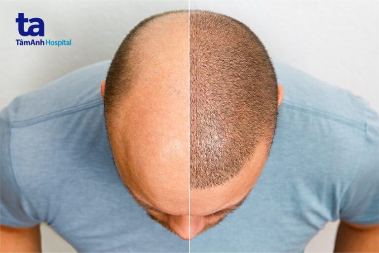 Hói Đầu Có Chữa Được Không? Sự Thật Bất Ngờ Bạn Nên Biết