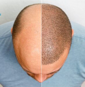 Khắc phục hói đầu bằng cấy tóc 
