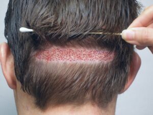 Nấm da đầu dẫn đến rụng tóc hói đầu