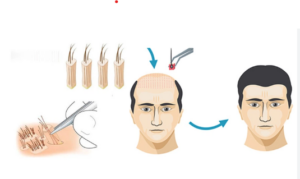 Quy trình cấy tóc