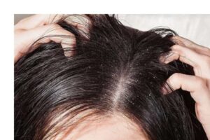 Không Chú Da Đầu Là Một Trong Những Thói Quen Gây Hại Cho Tóc 