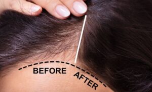 Thực hiện tiêm huyết tương giàu tiểu cầu để chữa rụng tóc