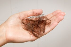 Nữ giới có nguy cơ rụng tóc nhiều hơn nam giới