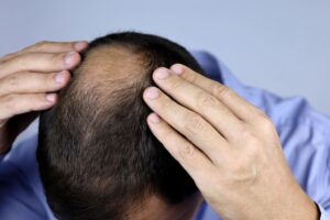 Nam giới cũng có thể bị rụng tóc bất thường như nữ giới