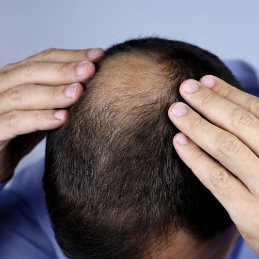 Khac Phuc Rung Toc 3 5cc9cb42d3