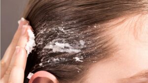 Baking soda giúp làm sạch da đầu và giảm lượng dầu thừa hiệu quả.