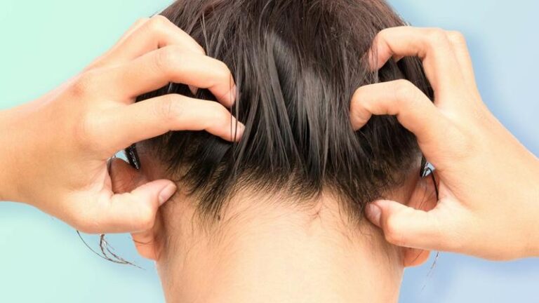 Da đầu nhạy cảm là gì? Chăm sóc da đầu nhạy cảm và giải pháp phù hợp
