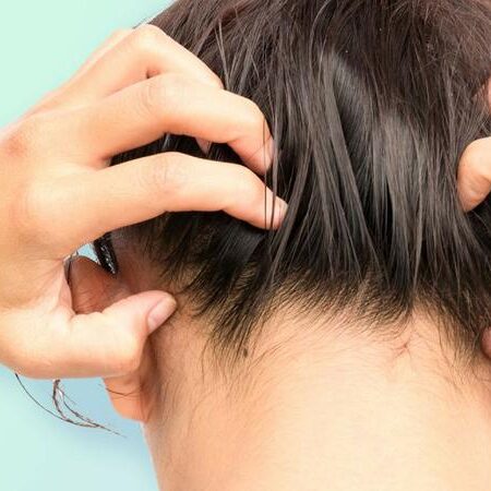 Da đầu Nhạy Cảm