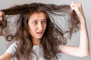 Da đầu dầu hay còn gọi là da đầu nhờn