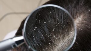 Chăm sóc tóc hàng ngày ảnh hưởng trực tiếp đến việc hình thành và tái phát gàu.