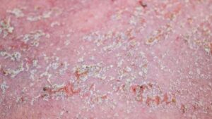 Viêm da tiết bã gây nên tình trạng da nhờn, dễ sinh ra gàu